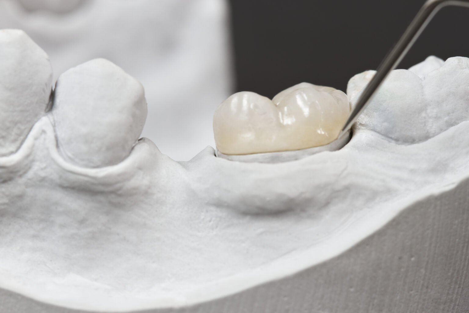 dental crowns in okanagan falls