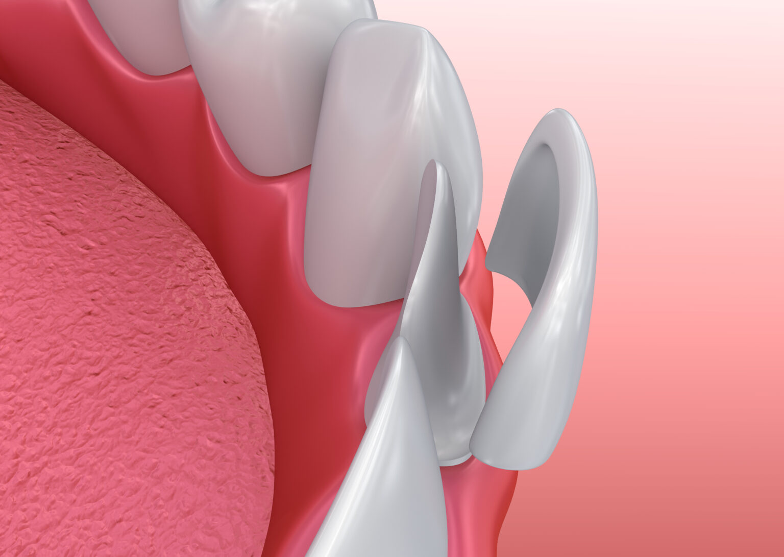 porcelain veneers in okanagan falls