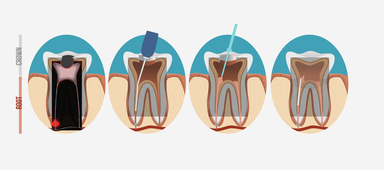 root canal treatment in okanagan falls