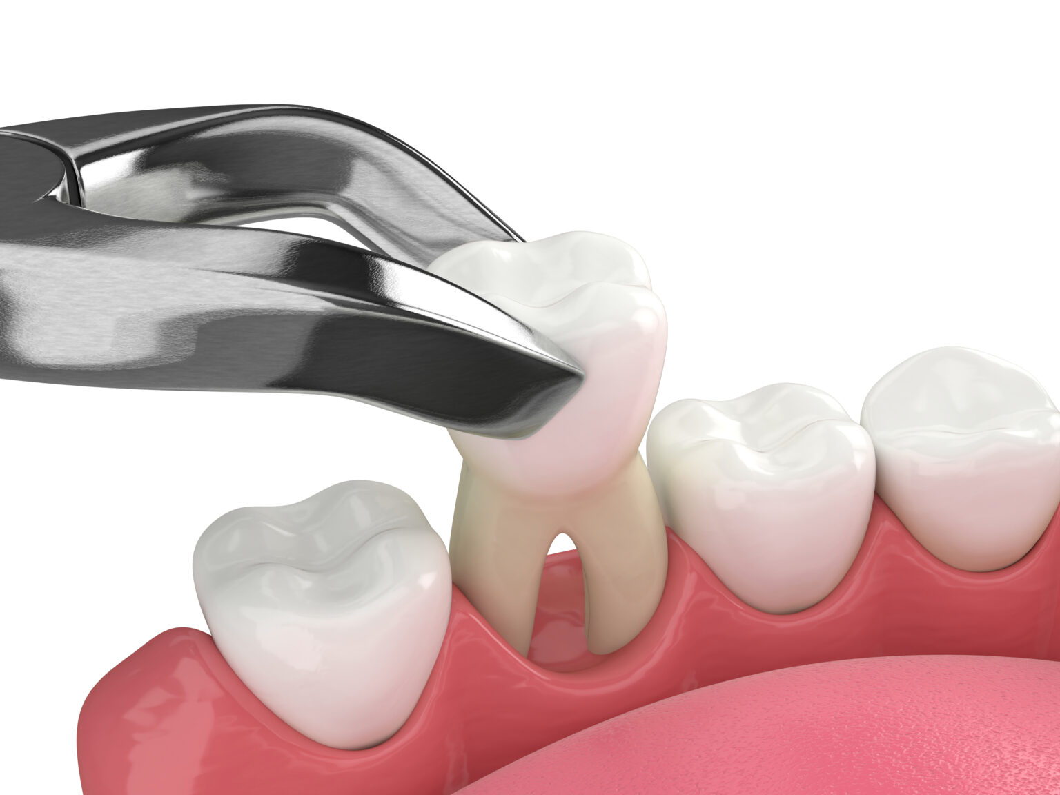 wisdom teeth extractions in okanagan falls