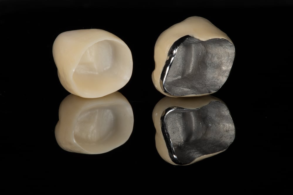 dental crowns in Okanagan Falls