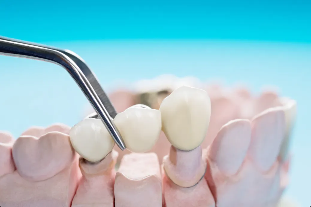 dental bridges boost confidence